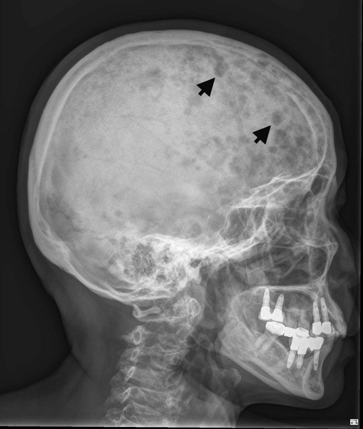 Multiple lytic lesions (arrows) on the skull