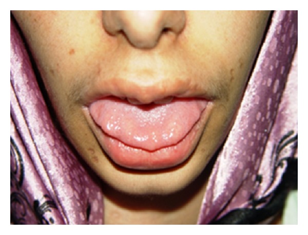 Multiple endocrine neoplasia neuromas of the tongue