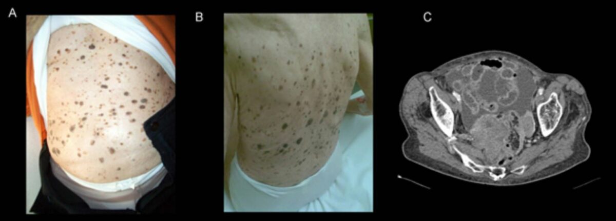 Multiple eruptive seborrheic keratoses