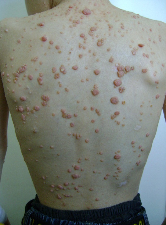 Multiple instances of molluscum contagiosum on the back of a child