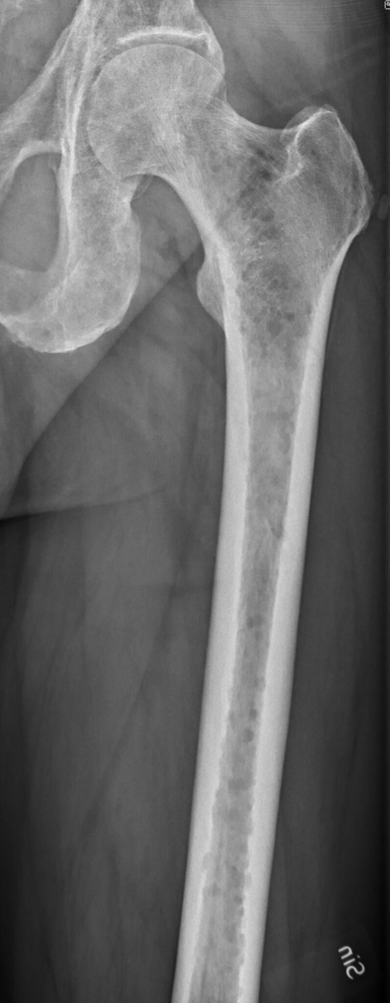 Multiple Myeloma Concise Medical Knowledge