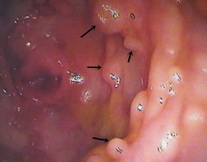 Multiple polyps in colon