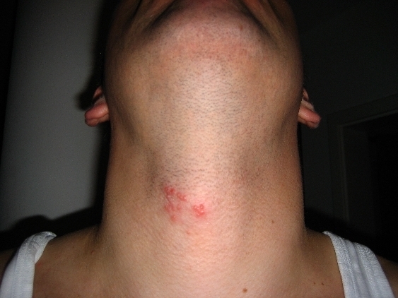 Multiple vesicles on the neck due to shingles