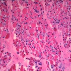 Muscle biopsy in SMA