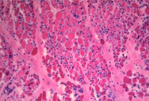 Muscle biopsy in sma
