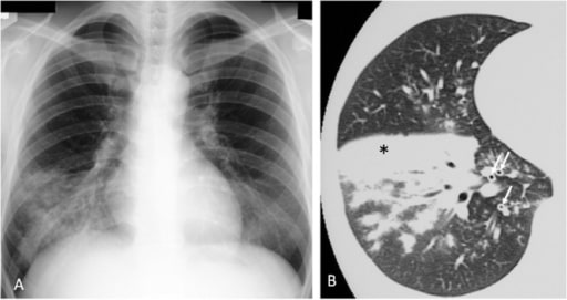 Mycoplasma pneumoniae pneumonia