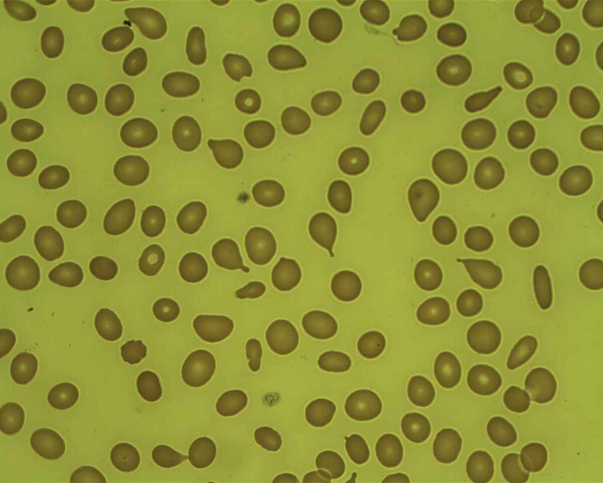 Myelofibrosis teardrop cells in peripheral smear