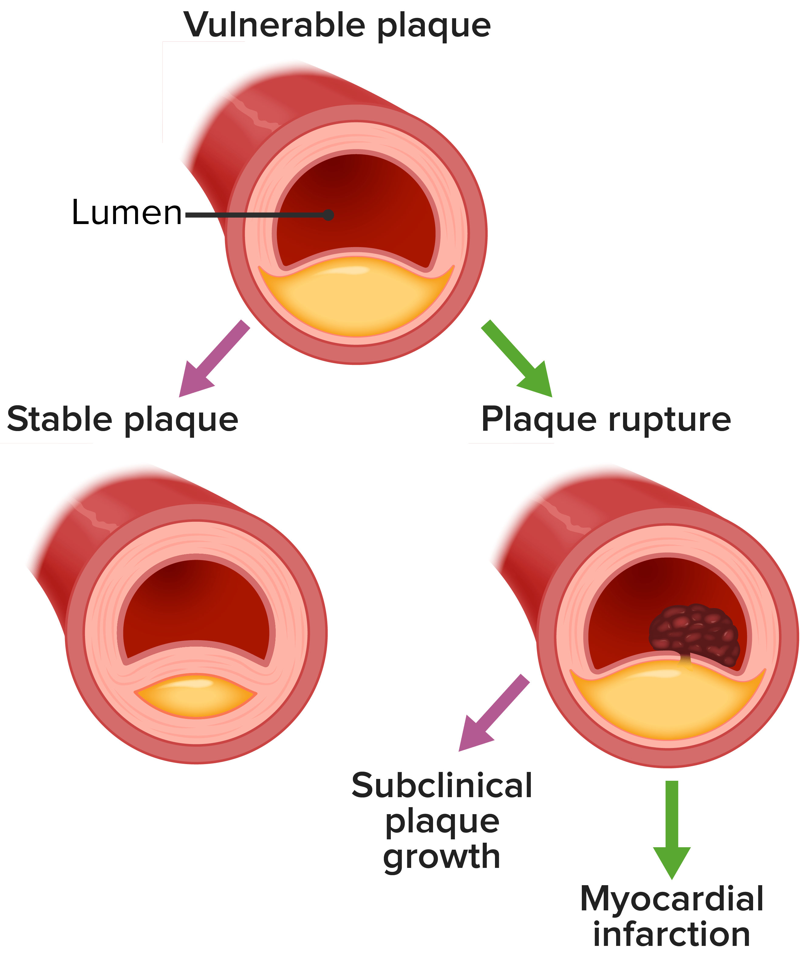 What Happens To The Body When Experiencing A Myocardial Infarction