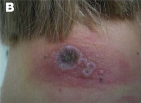 Neck lesions on a girl cowpox orthopoxviridae