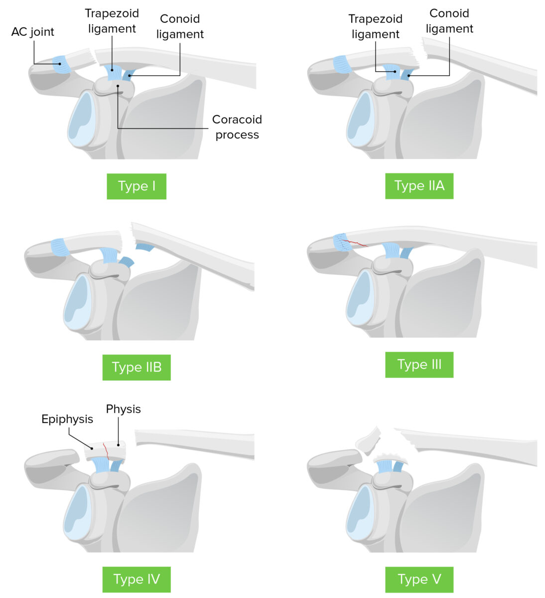 Classificação de neer para fraturas da extremidade distal da clavícula