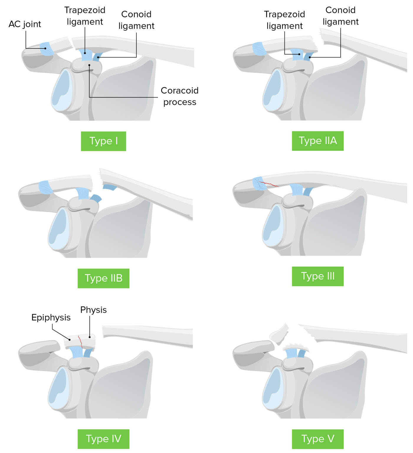 Clavicle Fracture | Concise Medical Knowledge