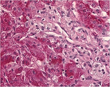 Neimann-pick cell from a sample of the liver showing swollen kupffer cells with foamy cytoplasm
