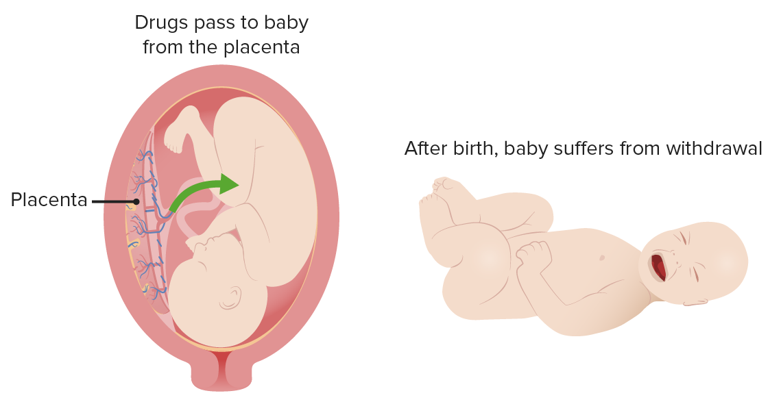 Síndrome de abstinência neonatal