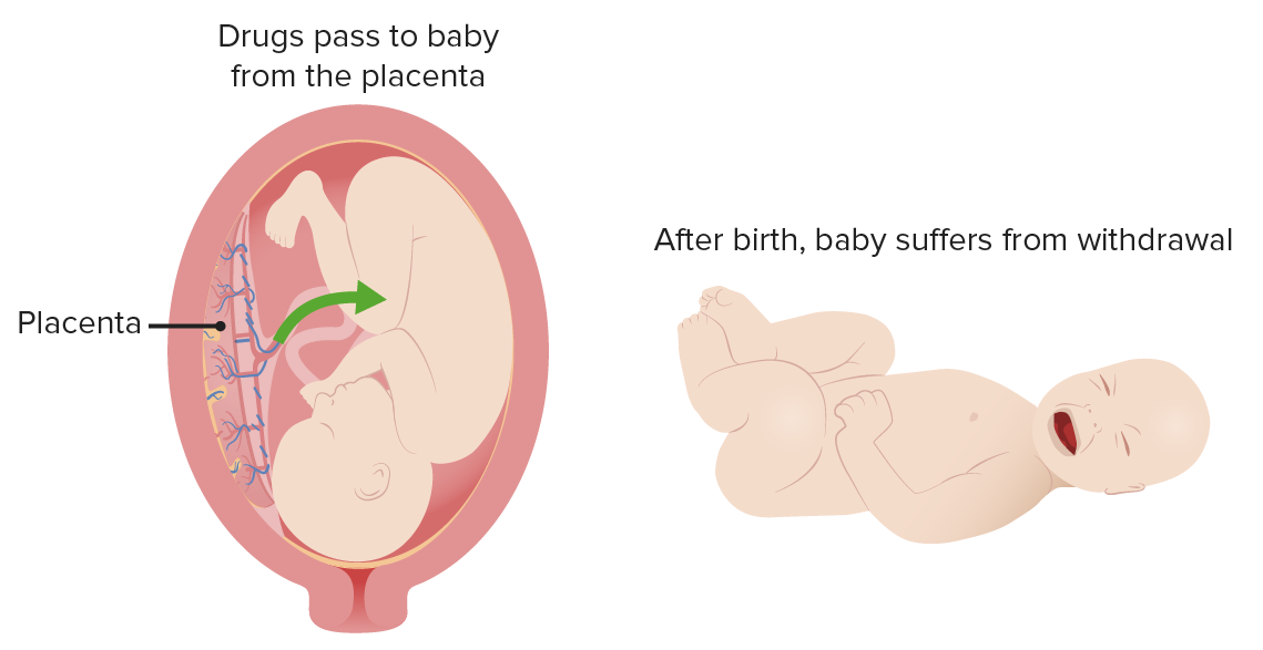 Neonatal Abstinence Syndrome Concise Medical Knowledge