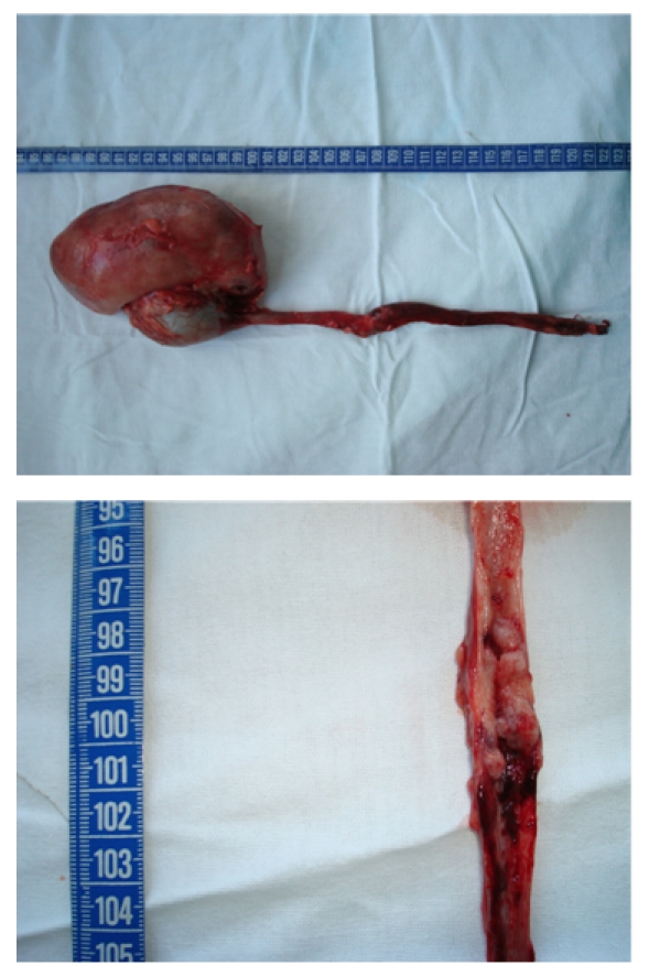 Nephroureterectomy in ureteral cancer