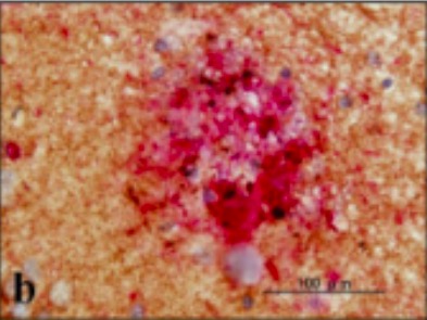 Neuritic plaque with a rim of dystrophic neurites surrounding an amyloid core
