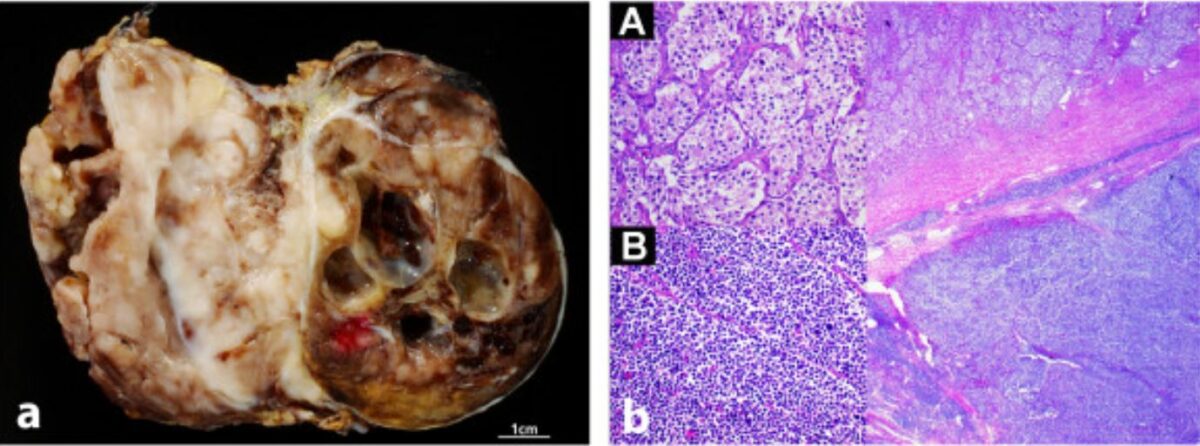 Aspecto macroscópico e histológico do neuroblastoma