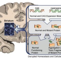 Neuronal changes in Huntington disease