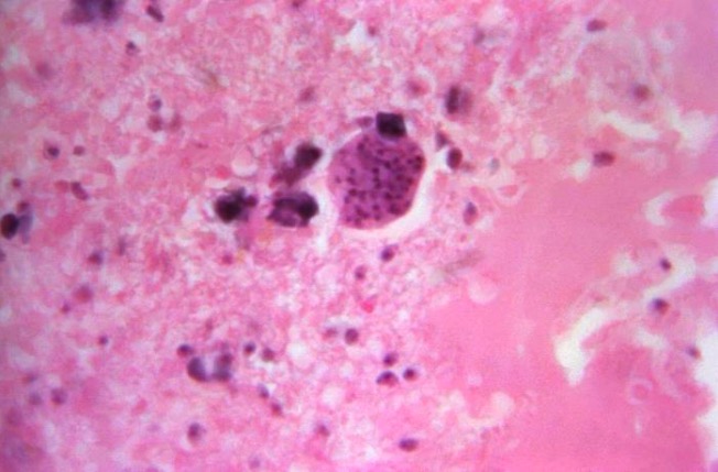 toxoplasmosis brain pathology