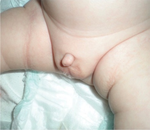 Newborn with charge syndrome micropenis