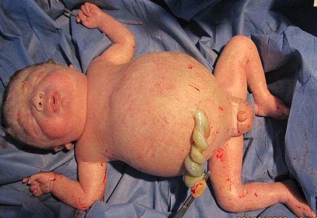 Newborn with hydrops fetalis