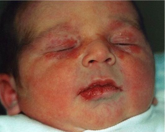 Newborn with upper and lower eyelid angiomatous-like lesions