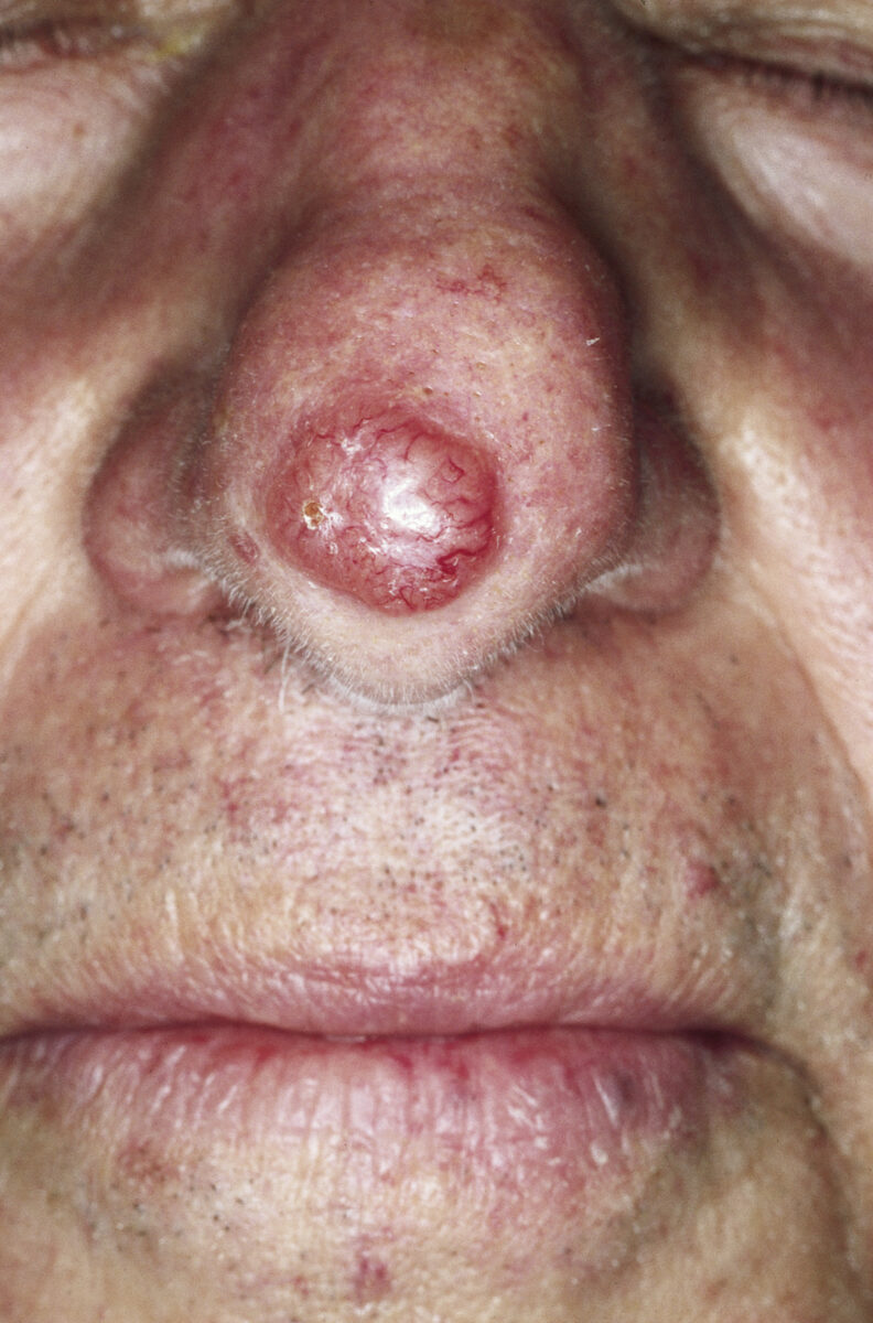 Nodular basal cell carcinoma of the nose