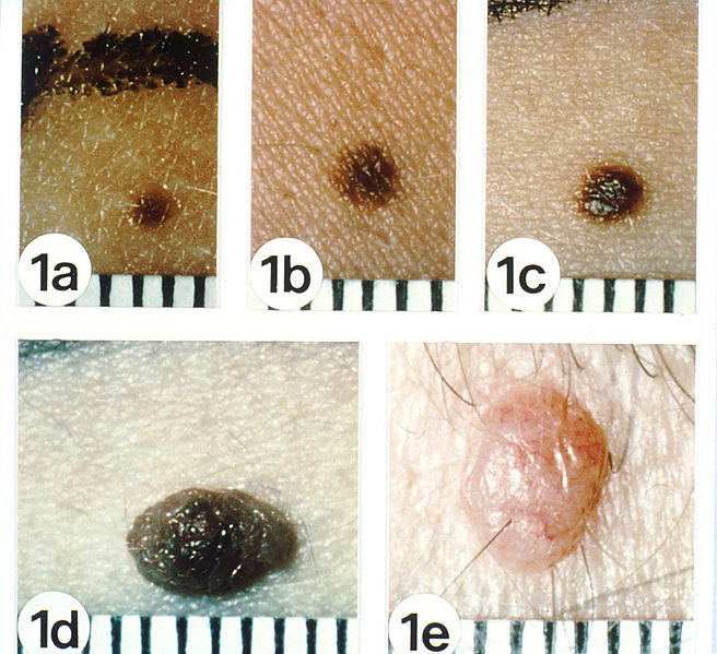 acquired melanocytic nevus