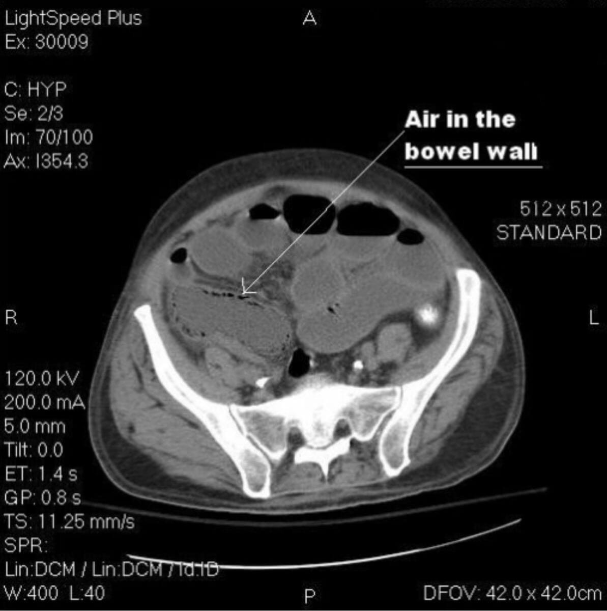 La tomografía computarizada sin contraste del abdomen y la pelvis (vista axial) muestra aire en la pared intestinal