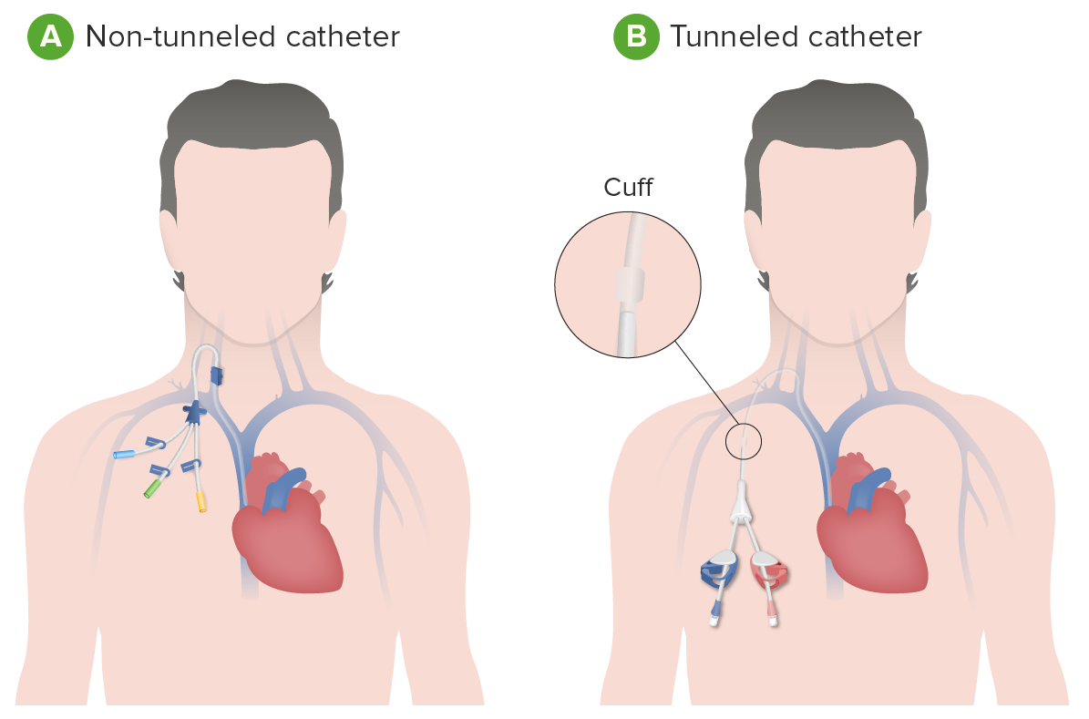 Nontunneled versus tunneled dialysis catheters