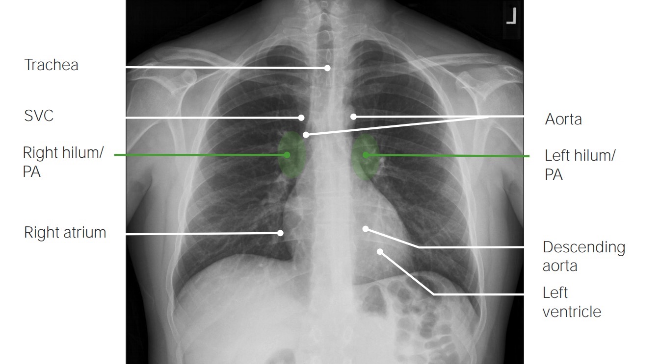 Normal pa view chest x-ray with labels 1