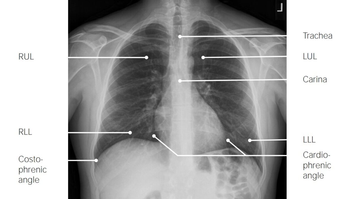 Imaging of the Lungs and Pleura | Concise Medical Knowledge