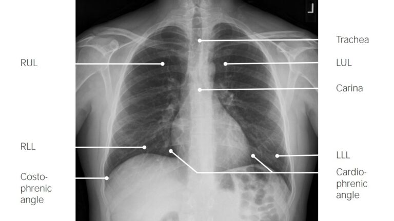 Imaging Of The Lungs And Pleura Concise Medical Knowledge Imaging Of The Lungs And Pleura Concise Medical Knowledge