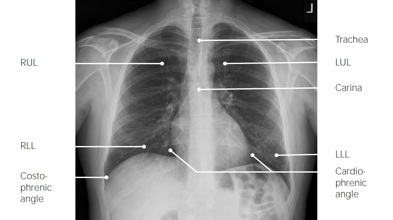 Normal pa view chest x-ray with labels 2