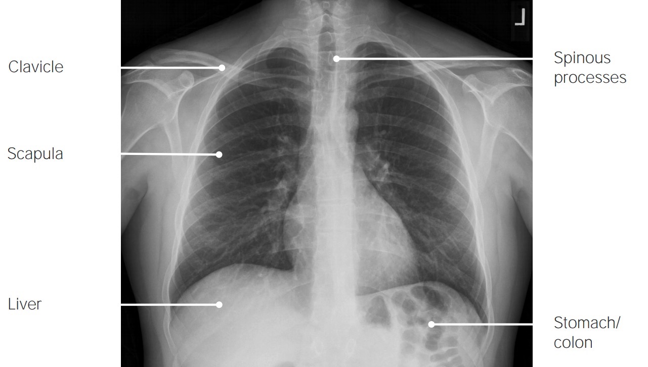 Normal pa view chest x-ray with labels 3
