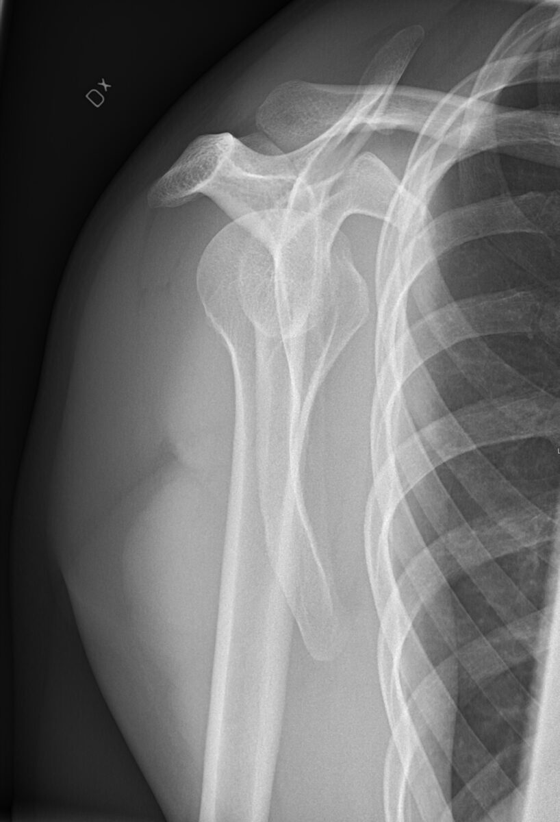 Normal y-view x-ray