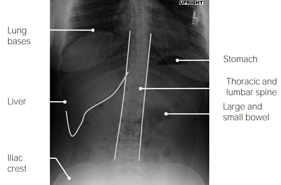 Normal abdominal radiograph