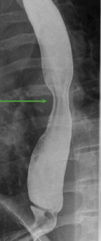 Normal barium swallow shows normal peristalsis (arrow)