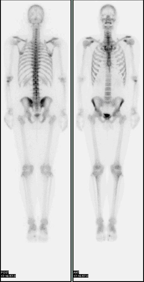 Normal bone scan with 2 views