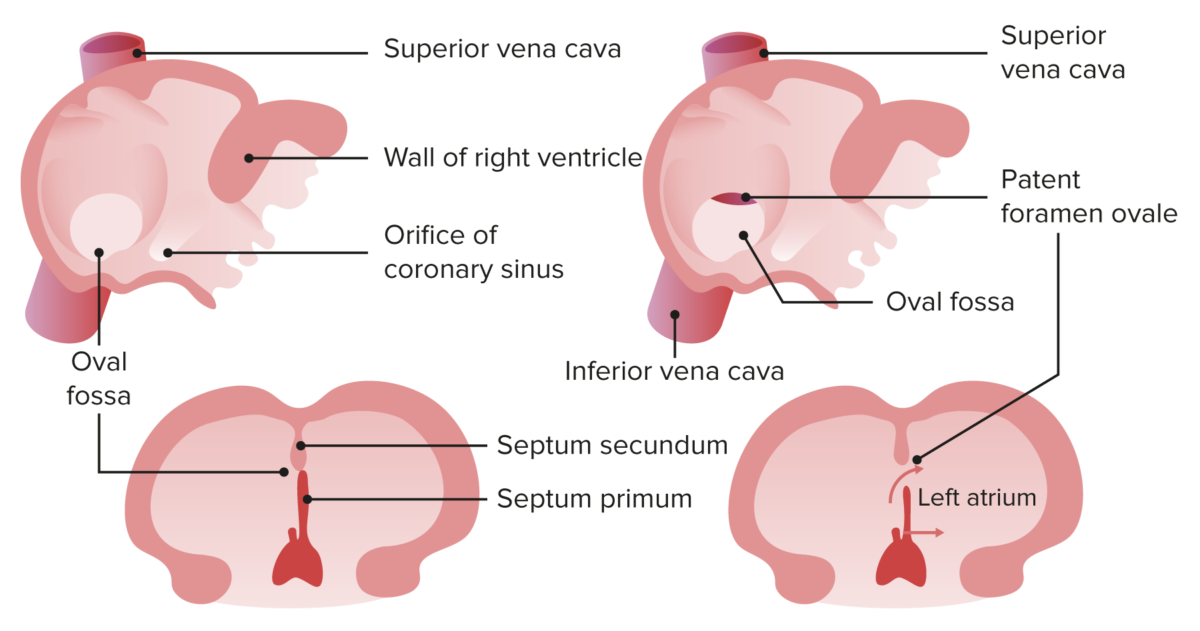 Cierre normal del foramen oval y foramen oval persistente