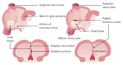 Normal closure of foramen ovale and patent foramen ovale