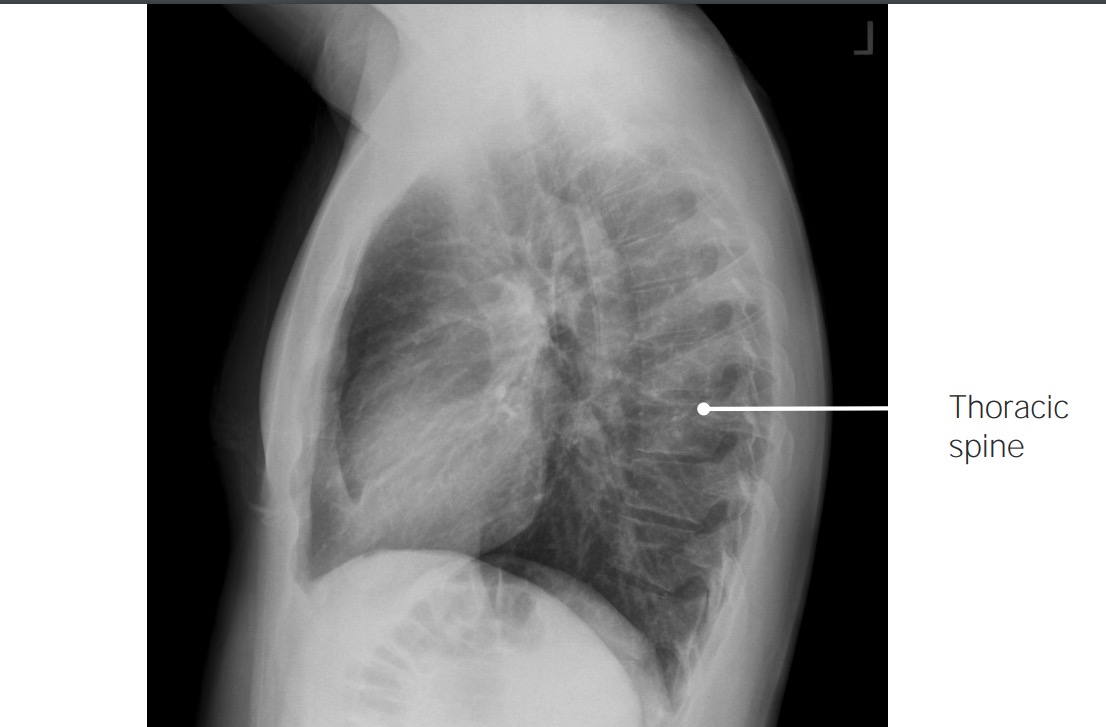 Normal findings on a lateral chest x-ray 3
