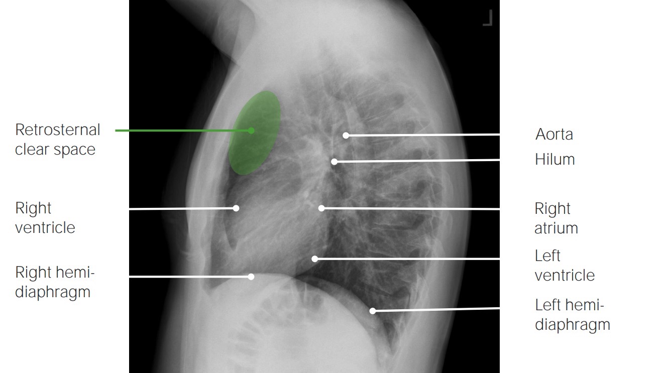 Normal findings on a lateral chest x-ray with labels 1