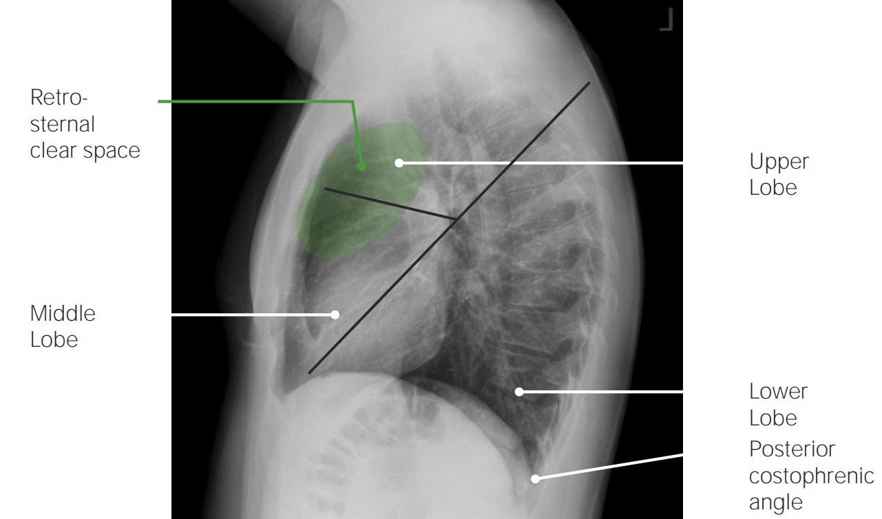 Normal findings on a lateral chest x-ray with labels 2