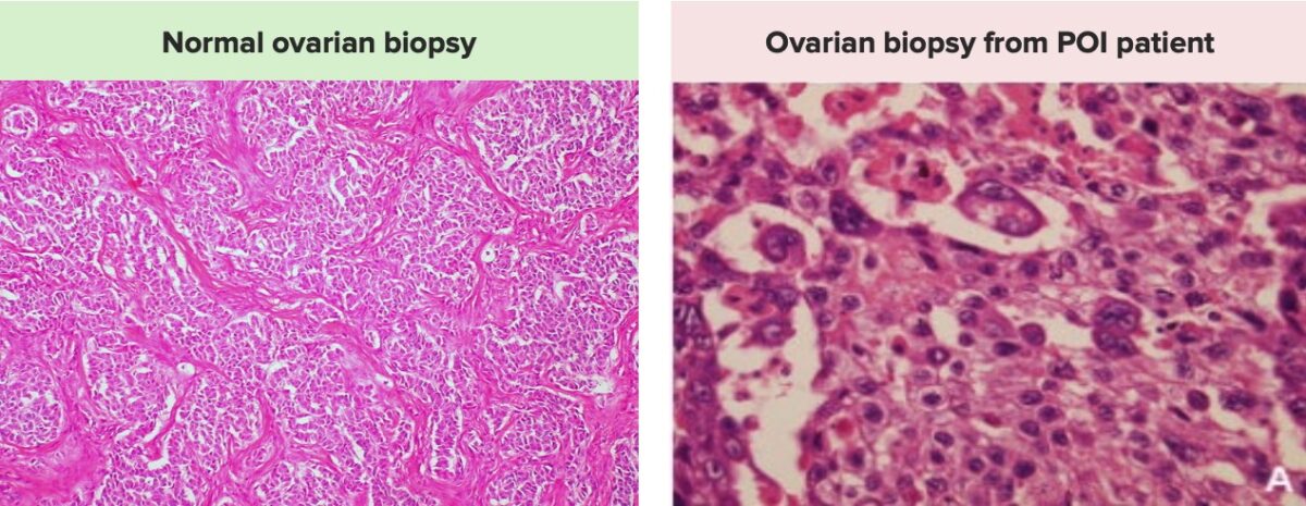 Histologia normal vs células tumorais do ovário