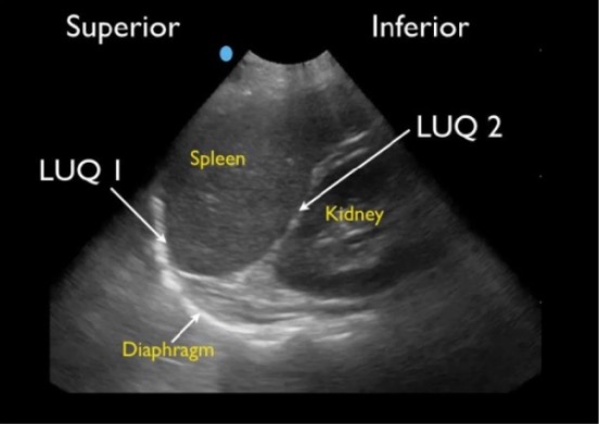 Normal left upper quadrant fast view showing spleno-diaphragmatic space