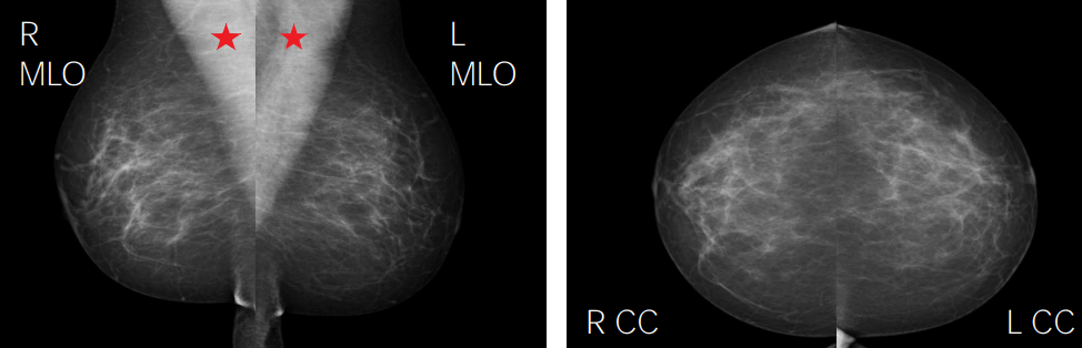 Normal mammogram, depicting fibroglandular tissue