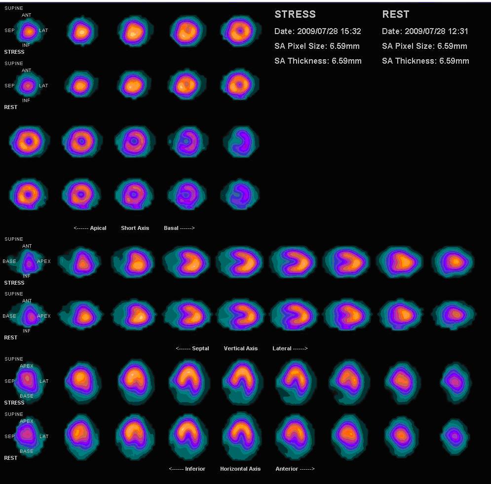 Gammagrafía de perfusión miocárdica normal con talio-201