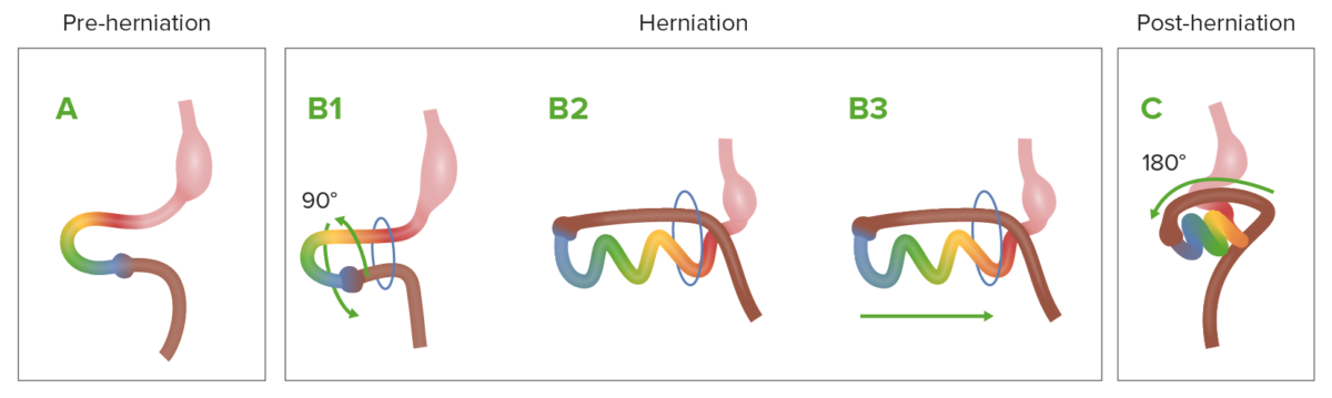 Normal process of herniation during embryologic development