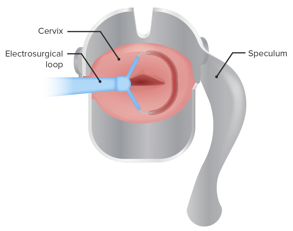 Representación esquemática de la conización cervical